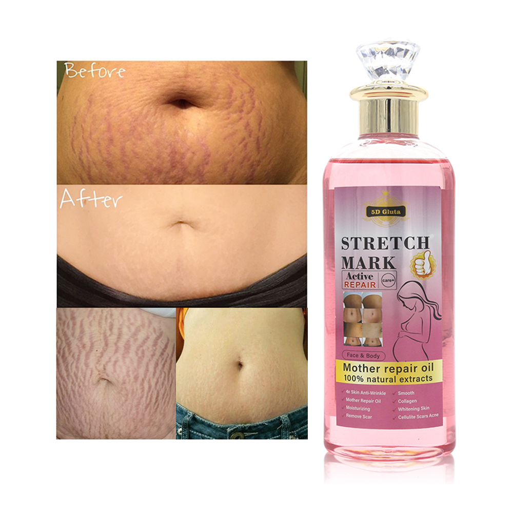 Stretch Mark Removal Oil Belly, Hands, Legs Marks Repairing Pregnancy Obesity Body Marks Removal Scar Moisturizing Repair Anti-Aging Anti-Winkles Cream Increase Skin Elasticity Smooth Firm