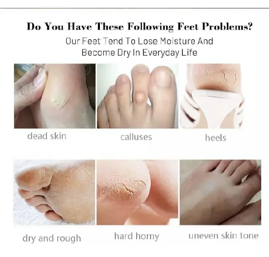 GuanJing Foot Skin Care Foot Mask Socks Peeling Remove Dead Skin Cells Moisturizing Exfoliating Foot Mask Exfoliating Gel Moisturizing For Women and Men 1 Pair