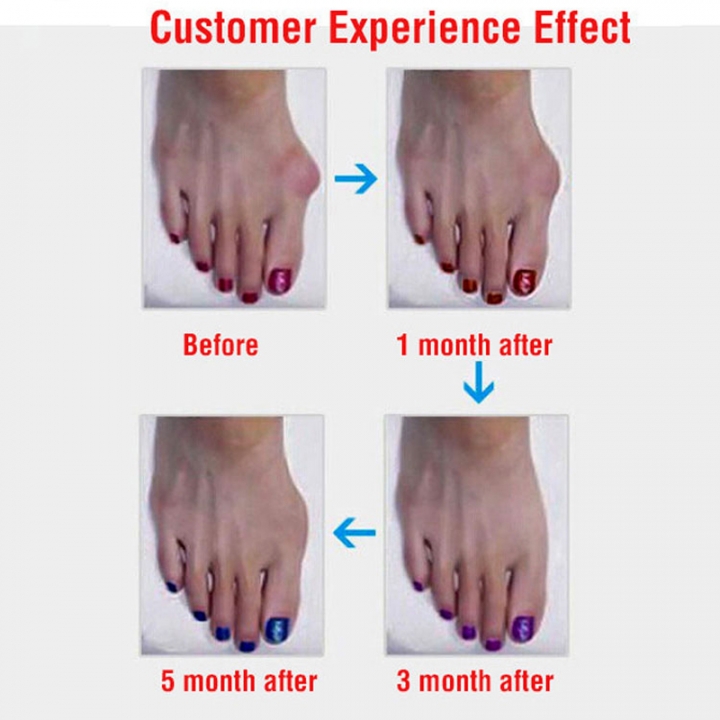 Big Toe Bunion Device Splint Straightener Hallux Valgus Pro Braces Toe Correction Foot Thumb Care