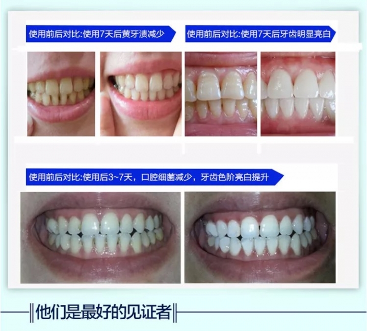 New style whitening paste 28 pieces of Advanced Teeth Whitening Strips tooth whitening paste