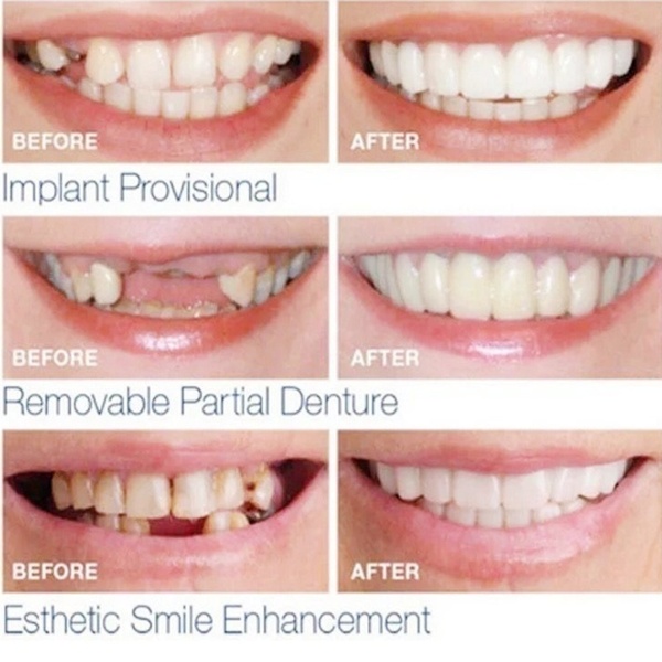 2 Pcs Upper and Lower Teeth Accessories Cover