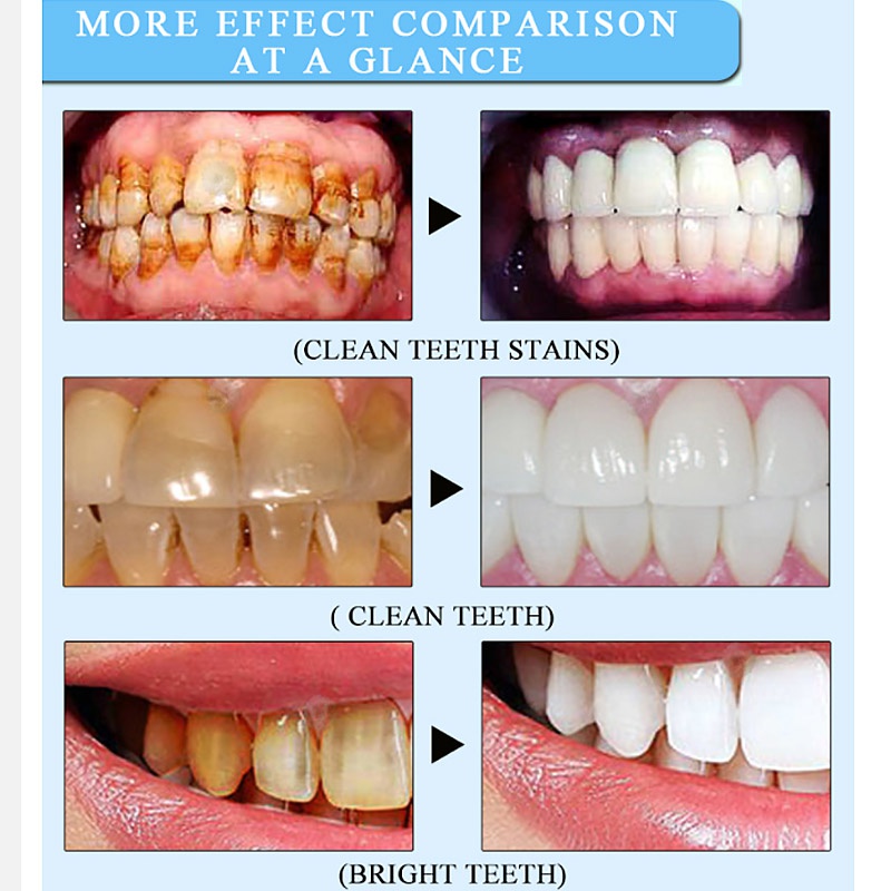 whitening gel pen oral care remove stains teeth cleaning tool whitening agent teeth whitening