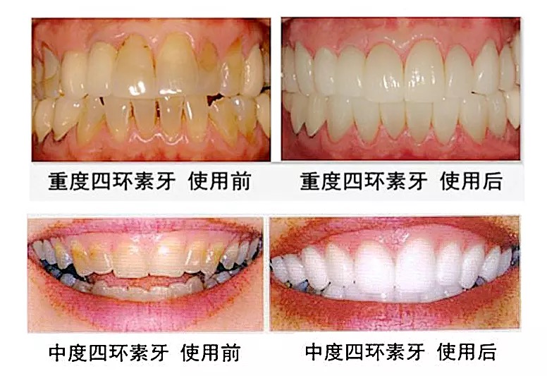 28pcs 3D White Gel Teeth Whitening Strips Oral Hygiene Care Double Strips Whitenin Bleaching Tools