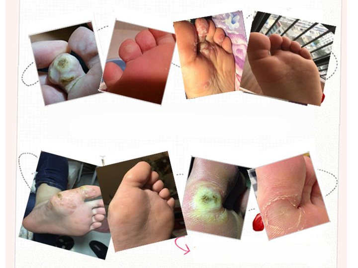 10pcs/lot Foot Care Medical Plaster Foot Corn Removal Calluses Plantar Warts Thorn