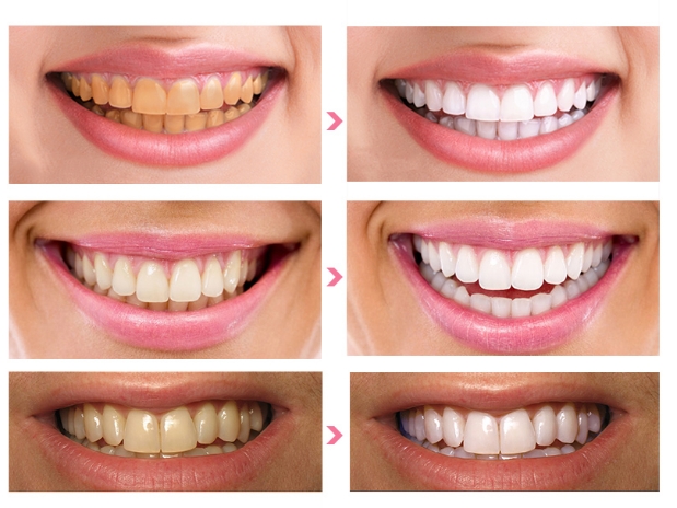 28pcs 3D White Gel Teeth Whitening Strips Oral Hygiene Care Double Strips Whitenin Bleaching Tools