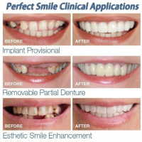 1 Pair Comfortable Perfect Whitening Teeth Fake Tooth Denture Cover Silicone Smile Veneers Beauty