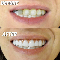 Comfortable Whitening Teeth Fake Tooth Denture Silicone Smile Veneers Beauty Tool False Tooth Oral