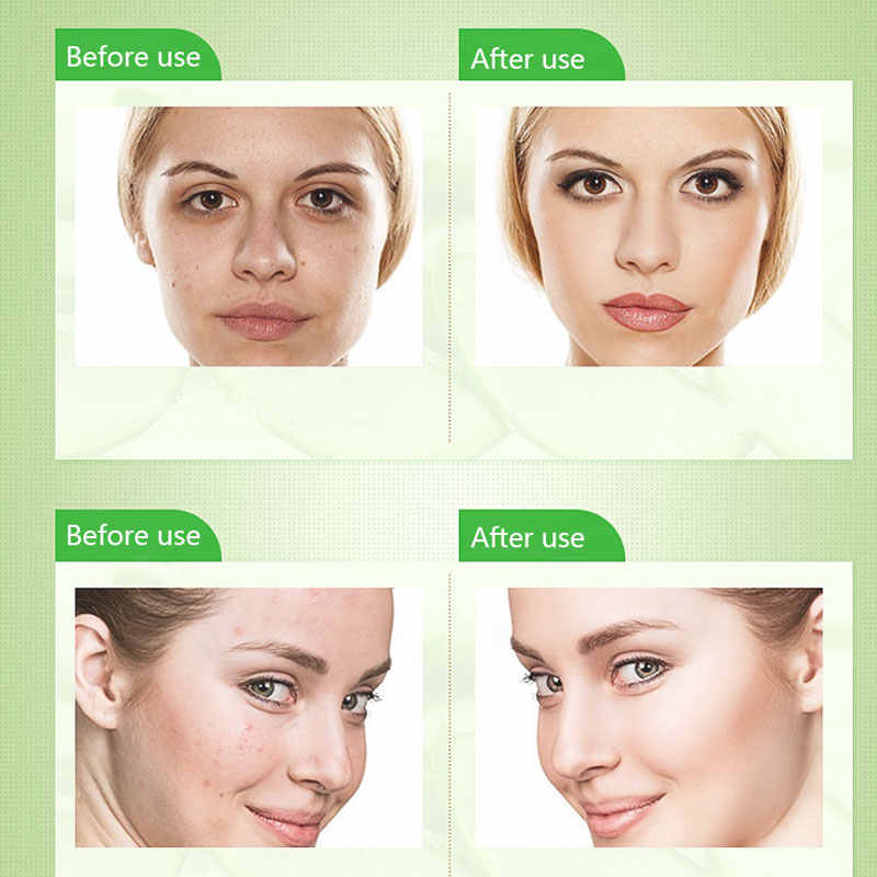 Dr-Rashel Aloe Vera Anti-Acne Pimple Cream 30g Green