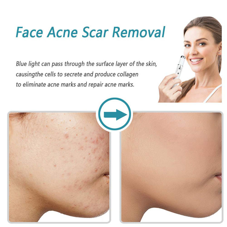 Acne Wrinkle Removal Laser Pen Skin Spots Removal Anti Varicose Veins Spider Vein Gum Treatment Portable Medical Blue Light Therapy