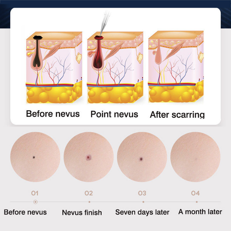 New Arrival 9 Levels LCD Laser Plasma Pen Mole Tattoo Freckle Wart Tag Removal Pen Dark Spot Remover For Face Skin Care Tools Beauty Machine