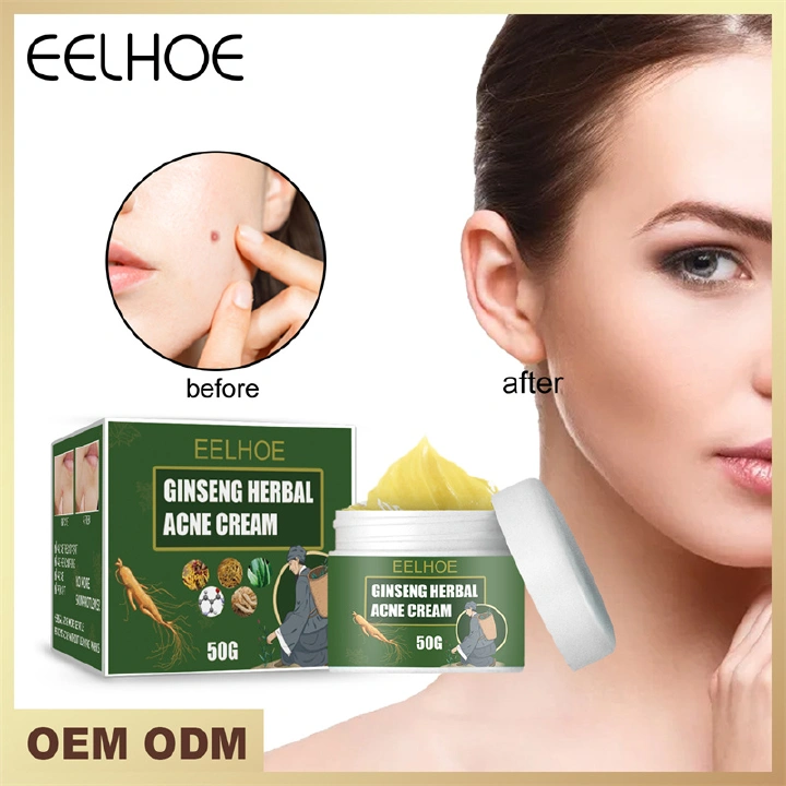 Ginseng herbal acne cream cleans and fades acne scars to acne repair acne pit acne cream