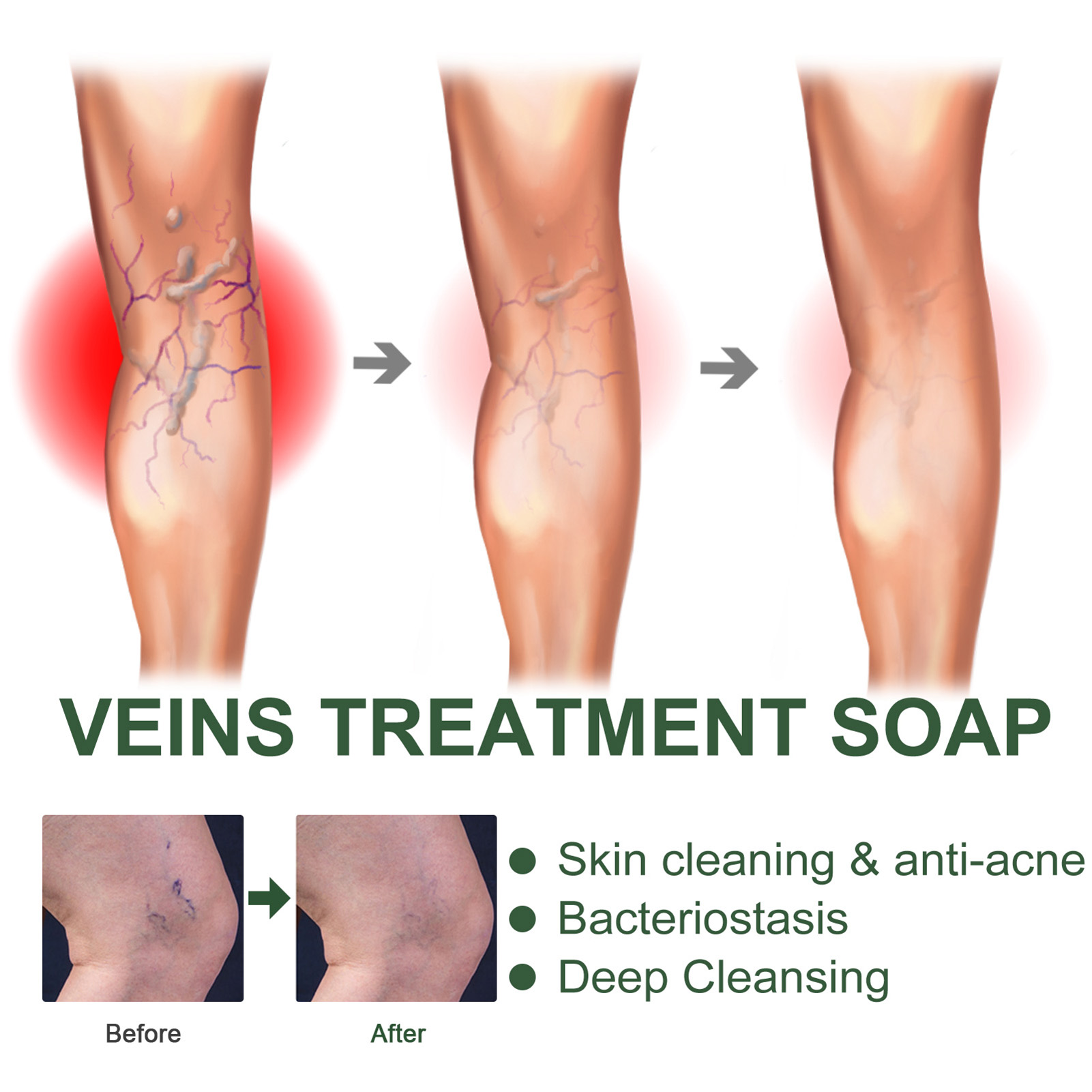 Ginger Varicure Healing Soap Varicoses Veins Cream Vasculitis Phlebitis Earthworm Spider Leg Cleaning Soap Pains Relieves Safety