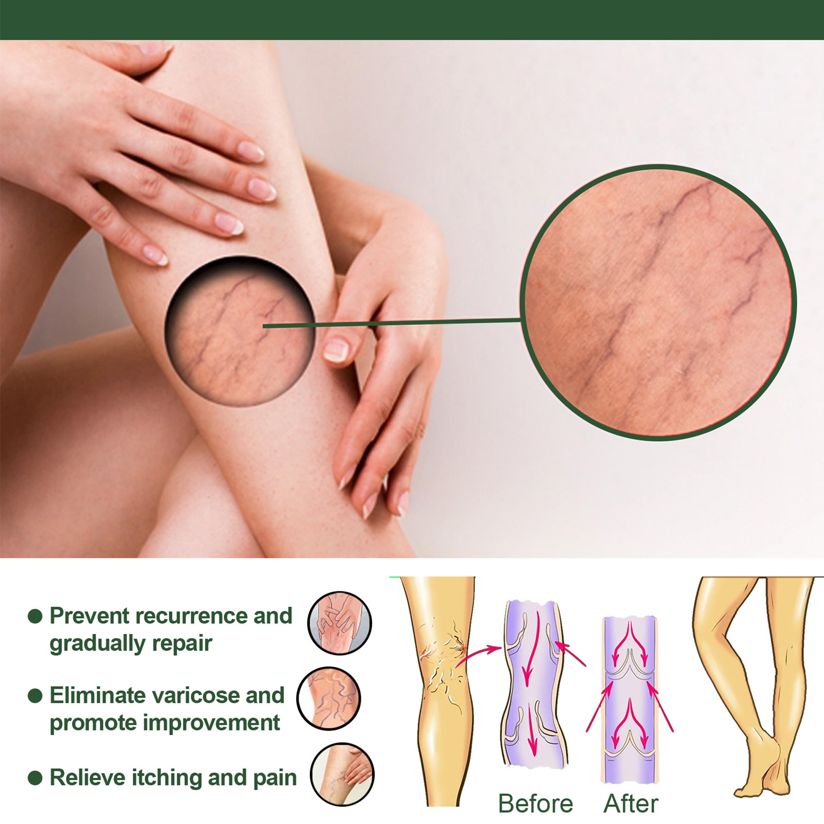 Ginger Varicure Healing Soap Varicoses Veins Cream Vasculitis Phlebitis Earthworm Spider Leg Cleaning Soap Pains Relieves Safety
