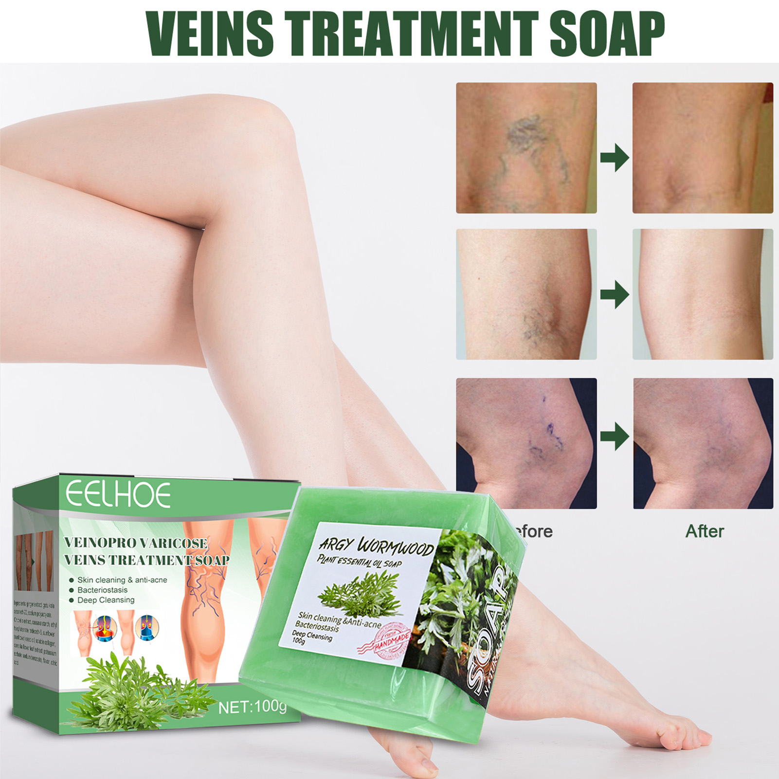Ginger Varicure Healing Soap Varicoses Veins Cream Vasculitis Phlebitis Earthworm Spider Leg Cleaning Soap Pains Relieves Safety
