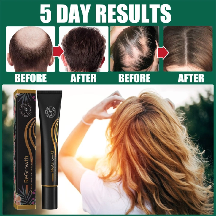 Hair Growth Roller Kit Thick Hair Growth Lotion Improve Hair Loss Strong Hair Anti-breakage Nourishing Hair Serum for Men Women
